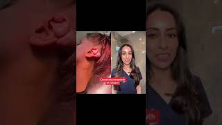 Keloid scars AFTER ear piercings! | Dr Adel #shorts