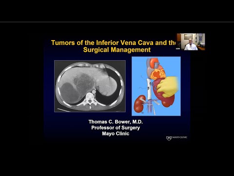 Video: Volledige Respons Van Niercelcarcinoom Vena Cava-tumor Trombus Op Neoadjuvante Immunotherapie