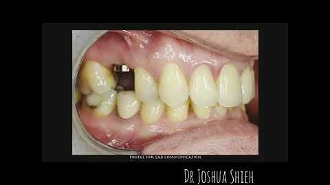 Atraumatic Extraction + Socket Graft + PRF + Single Tooth implant and Screw Retained Restoration #15