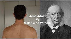 Acné Adulte Vs Maladie de Verneuil