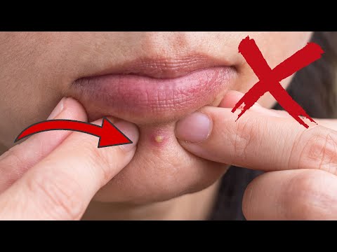 You should NEVER squeeze a Pimple in THESE Places 💥 (IMPORTANT) 🤯