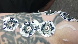 Electromyography electrode placement for optimal signal acquisition.
