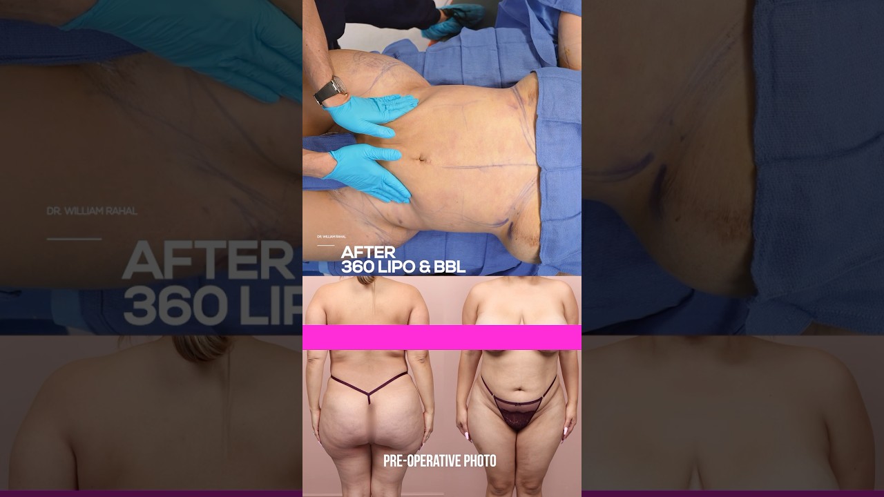 Transformation: Stunning Results of 360 Liposuction And Brazilian Butt Lift (bbl)