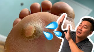 Wart Pops into Doctor's Face!...