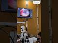 TRAUMA WITH IRON CHIPMANDATORY TO LOCATE IT BEFORE REPAIR!!!