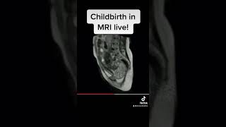 Childbirth in MRI: LIVE!!