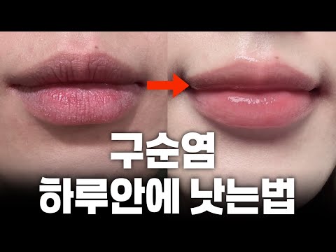 구순염 빨리 낫는법ㅣ구순염에 효과 있었던 찐템ㅣ내돈내산 건조하고 따가운 입술 보습 립밤 추천