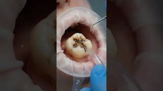 🦷 Realistic Dental Surgery ASMR (Step-by-Step Cavity Restoration) | Macro Cinematic 4K#science