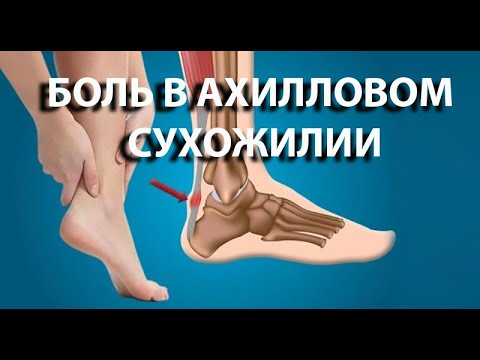 Видео: Было ли ахиллово сухожилие?