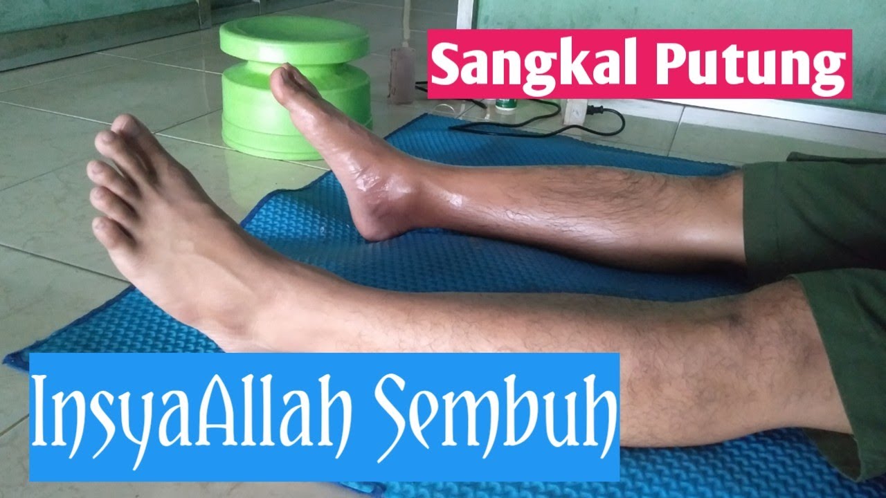 Sangkal Putung Patah Tulang dan Keseleo Tanpa Operasi, Pengobatan Alternatif #pijat #sangkalputung