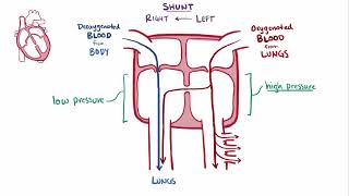 Ventricular Septal Defect | Osmosis