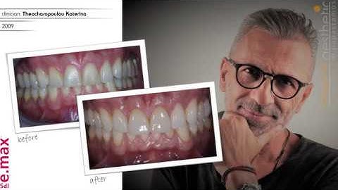 Ivoclar e.max: 4 veneers with cut back technique