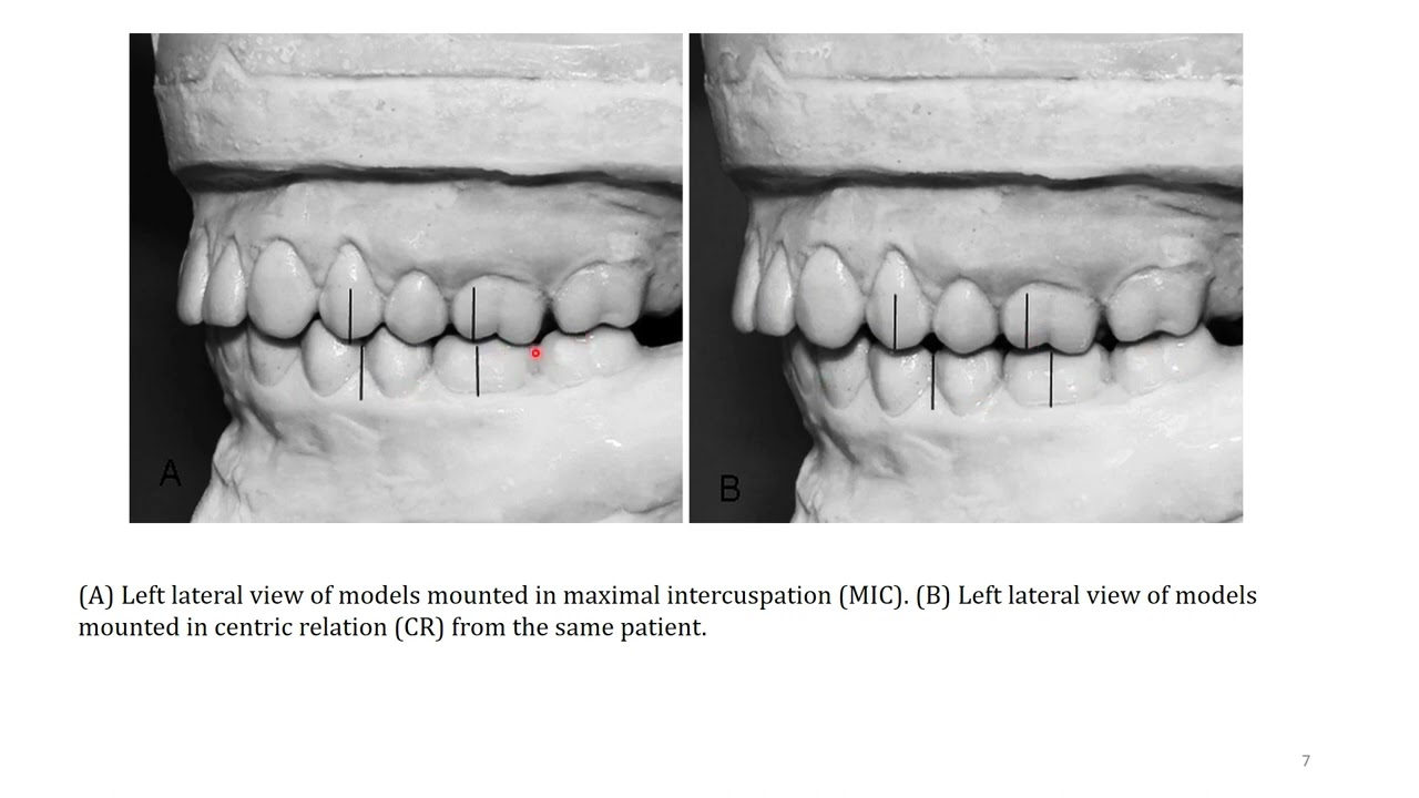 OCCLUSION IN FIXED PROSTHODONTICS - YouTube