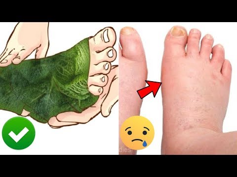 water-retention-after-pregnancy-|-natural-treatments-for-postpartum-edema-#naturalremedies