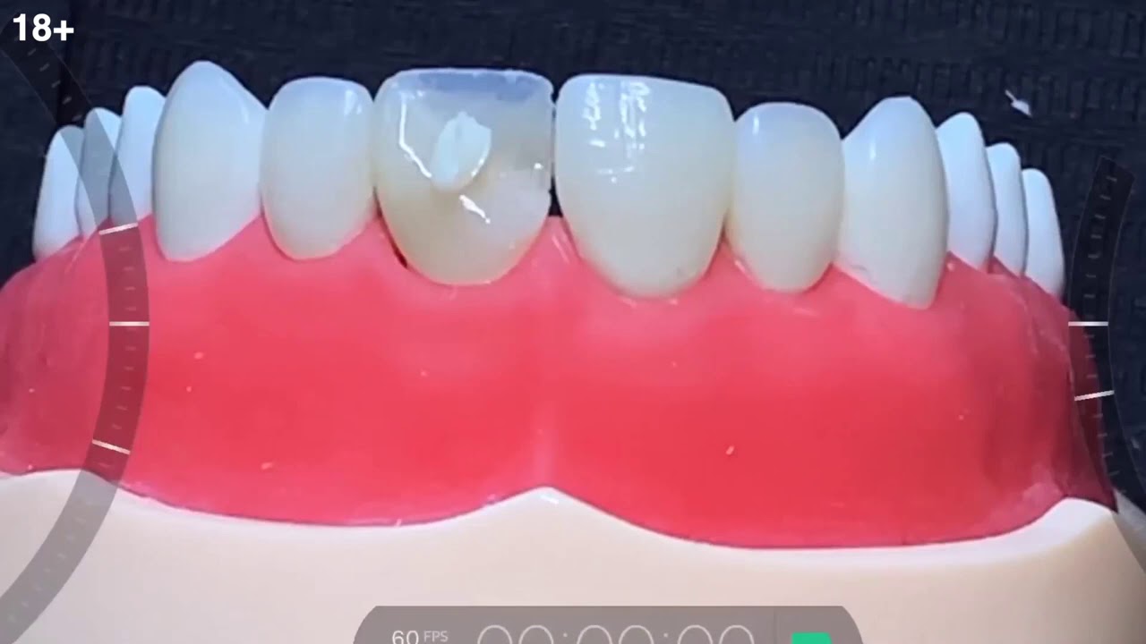 Как правильно сделать построение нёбной стенки? Какова её толщина?  Пошаговый протокол реставрац