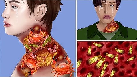 ASMR Remove maggot from infected neck _ ASMR Animation Treat