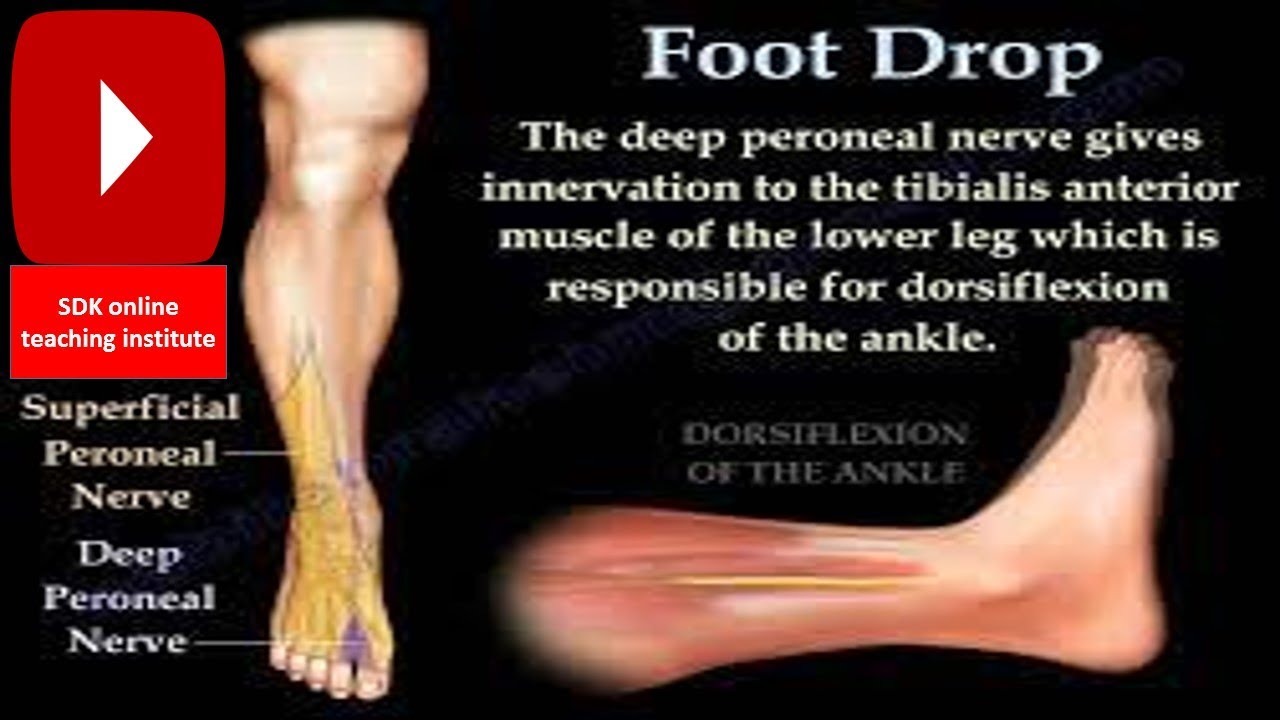 What is a drop foot? YouTube