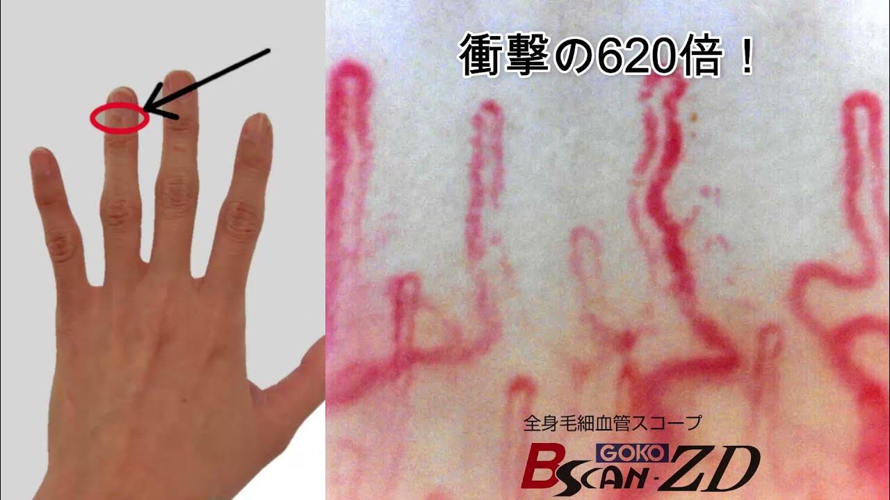 指先の毛細血管を620倍マイクロスコープで拡大。日本製毛細血管スコープGOKO Bscan-ZD。