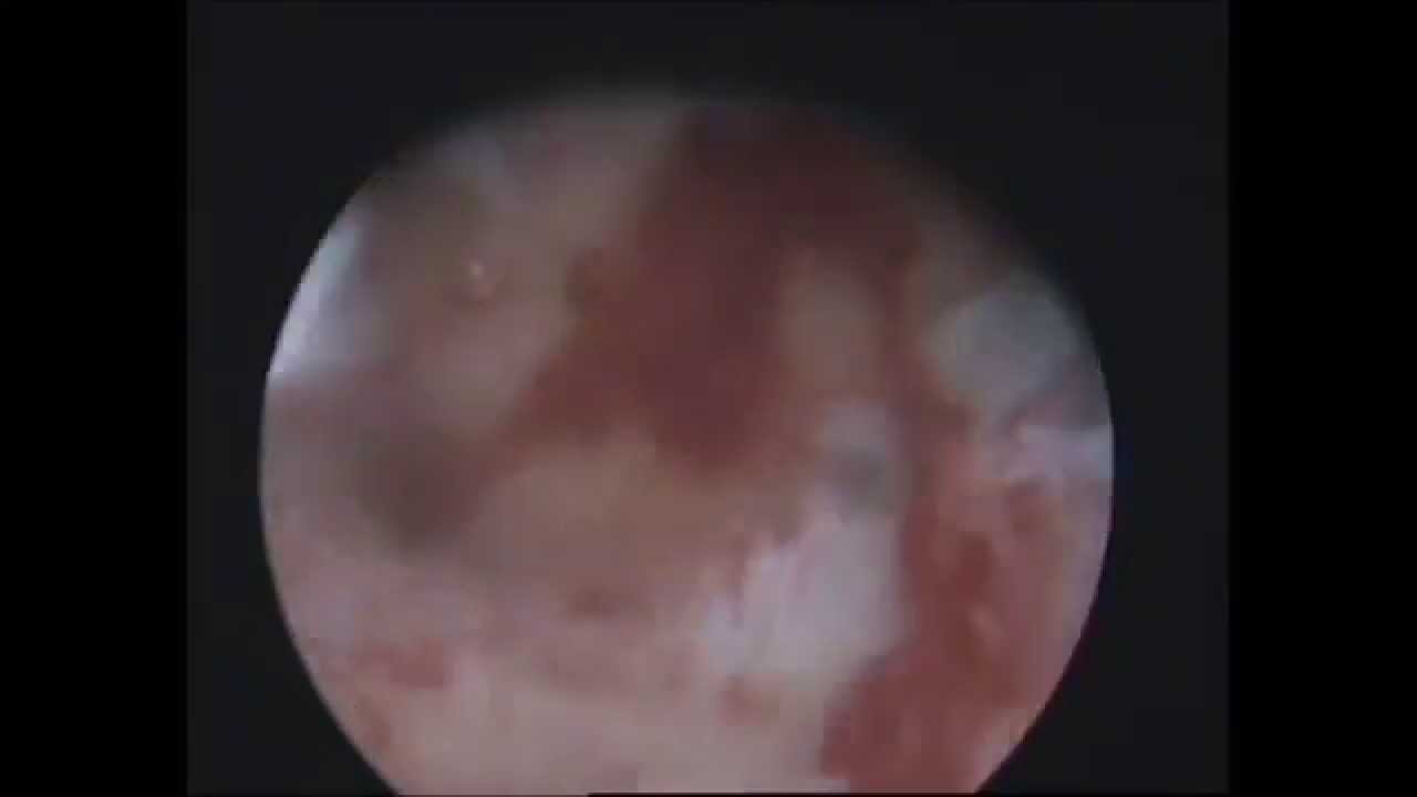 ГС. Хронический эндометрит с гноетечением. - YouTube