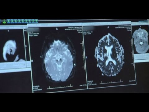 Stroke Associated with Both Immediate and Long-term Decline in Cognitive Function