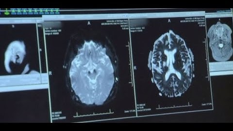 Stroke Associated with Both Immediate and Long-term Decline in Cognitive Function