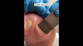 Thick callus removal#callustreatment #callusremover 