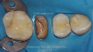 Deep Margin Elevation