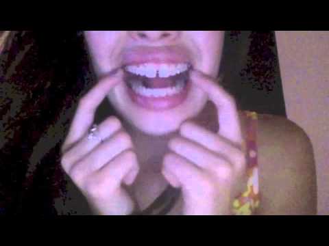 braces gap