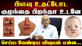 பிறவி பிளவு உதடு பிரச்சினைக்கு நவீன சிகிச்சை| plastic surgery treatment for Cleft lip & cleft palate