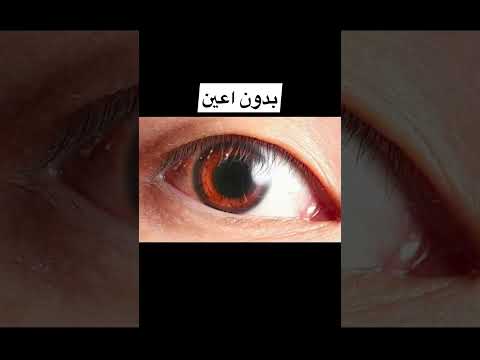 أشخاص ولدو بدون أعضاء      