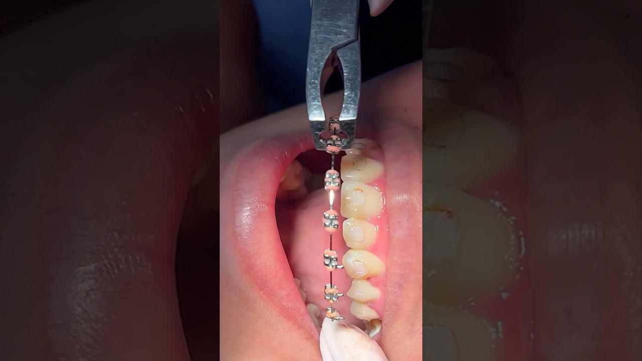 This Is Why Getting Braces Removed Is PAINLESS! 😃🦷