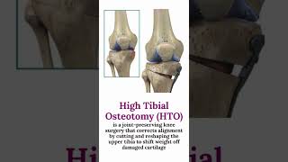 Knee Replacement Isn't Your Only Option (HTO Explained)#KneePain #htown