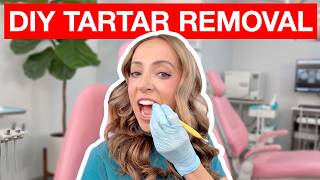 You Think You Removed Tartar at Home… Here’s the Problem
