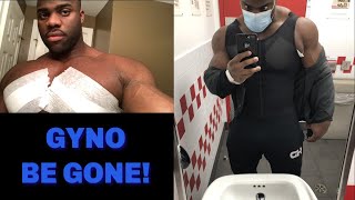 Post Gynecomastia Surgery Update