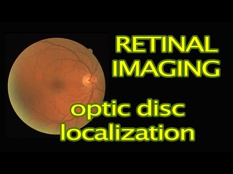 Video: Kev O Ntawm Optic Disk Hauv Retina Ntawm Miv