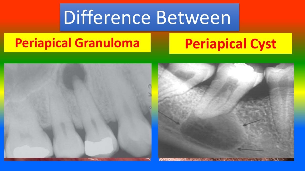 Periapical Granuloma Vs Cyst