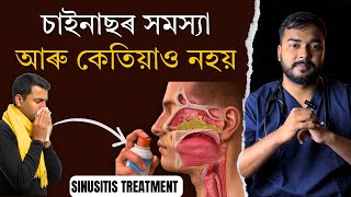 চইনছৰ সমসযৰ ঘৰৱ উপয Sinusitis Treatment In Amese Dr. Hriday J Deka