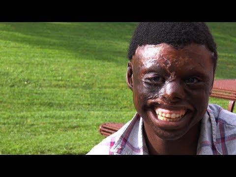 African Burn Survivor Jespa Awomah Finds Hope, Education in California