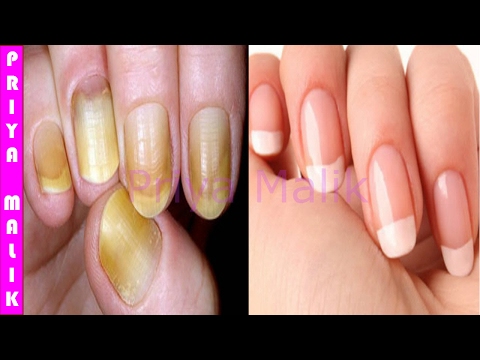 नाखूनों को सफ़ेद करने के लिए सबसे अच्छा तरीका~ Only in 10 minutes | How to Whiten  your Yellow Nails