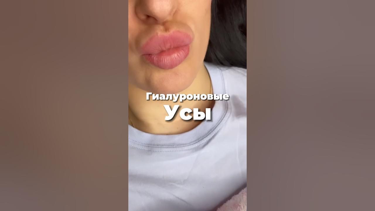 Гиалуроновые усы фото примеры
