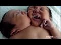 Two-headed baby: Amazing conjoined twins born in China