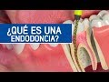 Cómo es una endodoncia, matar el nervio dental / Odontoespecialistas