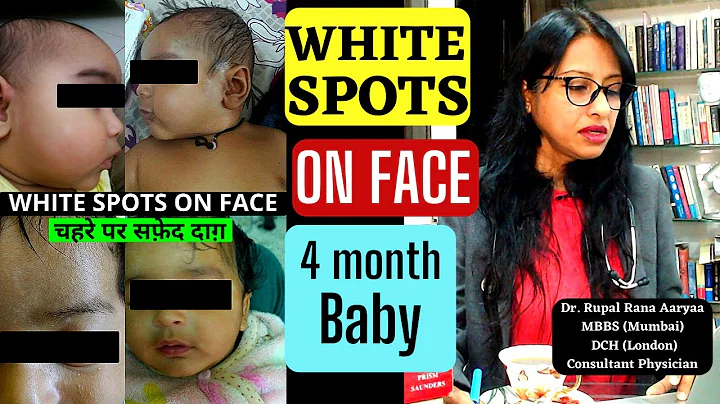 Baby With White Spots on Face , Any TREATMENT ? बच्चे के चेहरे पर सफ़ेद दाग़ ( safed daag ) ijaaj ? - DayDayNews