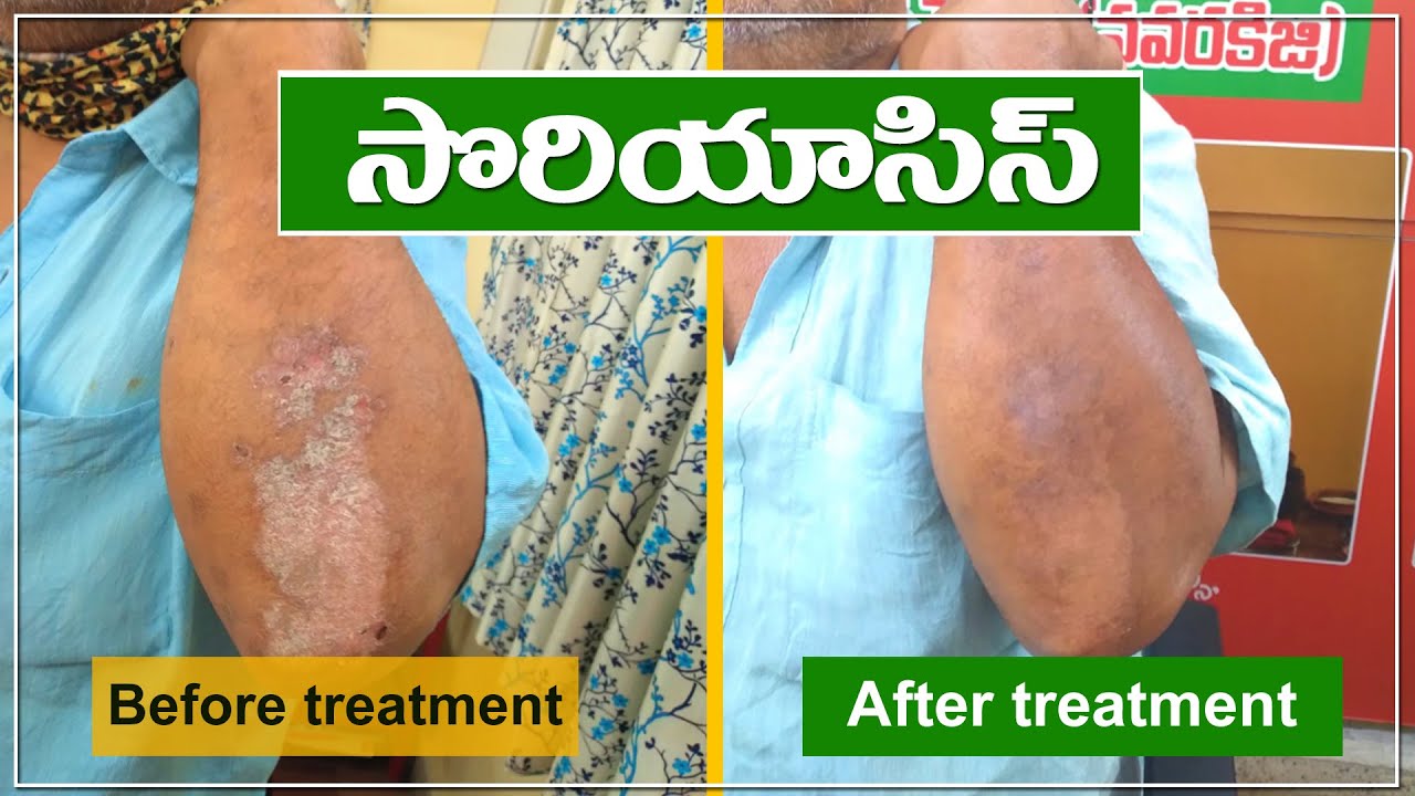 Psoriasis Testimonial II Sri Bhaskara Kerala Ayurvedic Hospital II