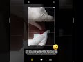 坐立難安的巨大 疔瘡 看看院長巧手如何化險為夷 美麗專線 08 7383299 08 7387299吳仁欽皮膚科診所屏東市自由路319 2號 吳仁欽皮膚科診所 屏東醫美 567 坐立難安的巨大 疔瘡 看看院長巧手如何化險為夷 美麗專線 08 7383299 08 7387299吳仁欽皮膚科診所屏東市自由路319 2號 吳仁欽皮膚科診所 屏東醫美 567