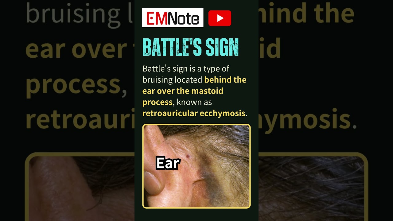 Battle Sign Seen In