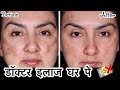 Remove Dark Spots, Pigmentation - Doctor Treatment at Home  | How To get Clear Skin | JSuper Kaur