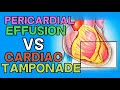 PERICARDIAL EFFUSION vs CARDIAC TAMPONADE - EXPLAINED IN 5 MINUTES (Beck's Triad, Causes, Diagnosis)