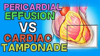 PERICARDIAL EFFUSION vs CARDIAC TAMPONADE - EXPLAINED IN 5 MINUTES (Beck