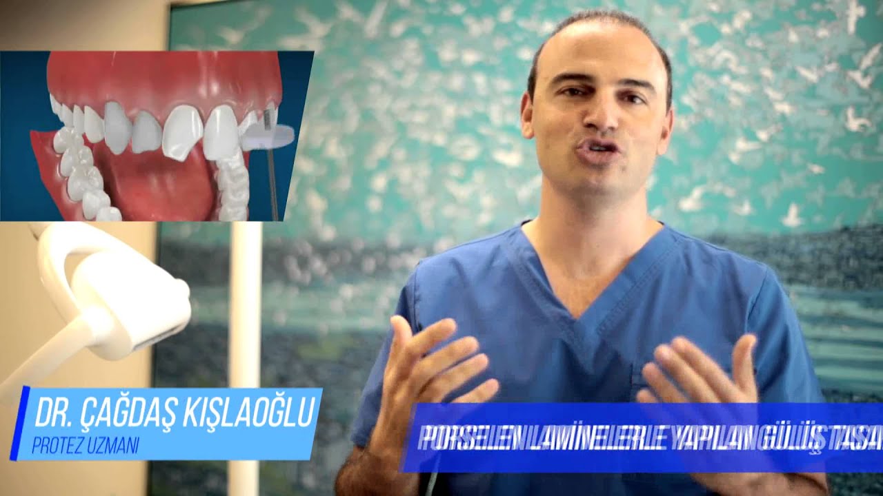 Dr Cagdas Kislaoglu Dis Hekimi Protez Uzmani Lamine Uygulamasi Ile Kisa Surede Disleriniz Estetik Bir Gorunume Kavusabilir Http Www Estetikdishekimi Com Dis Hekimi Cagdas Kislaoglu Tel 90 216 302 80 80 90 539 216 44 44 Whatsapp